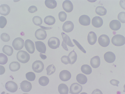 Hemat&iacute;es falciformes (alargados) en un paciente con drepanocitosis