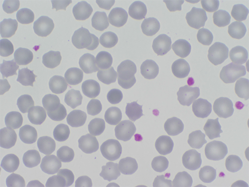 Esferocitos (más pequeños y densos) en un paciente con esferocitosis hereditaria
