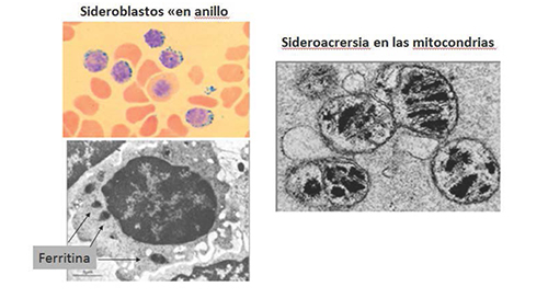 Sideroblastos en anillo (eritroblastos con hierro intramitocondrial) en la anemia siderobl&aacute;stica