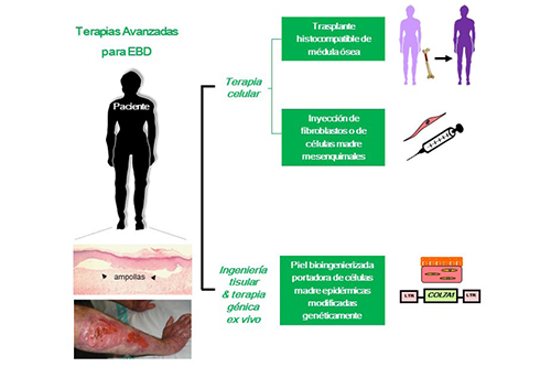 Terapias avanzadas para la epidermolisis bullosa distr&oacute;fica (EBD). Esquema de las diferentes estrategias terap&eacute;uticas en desarrollo